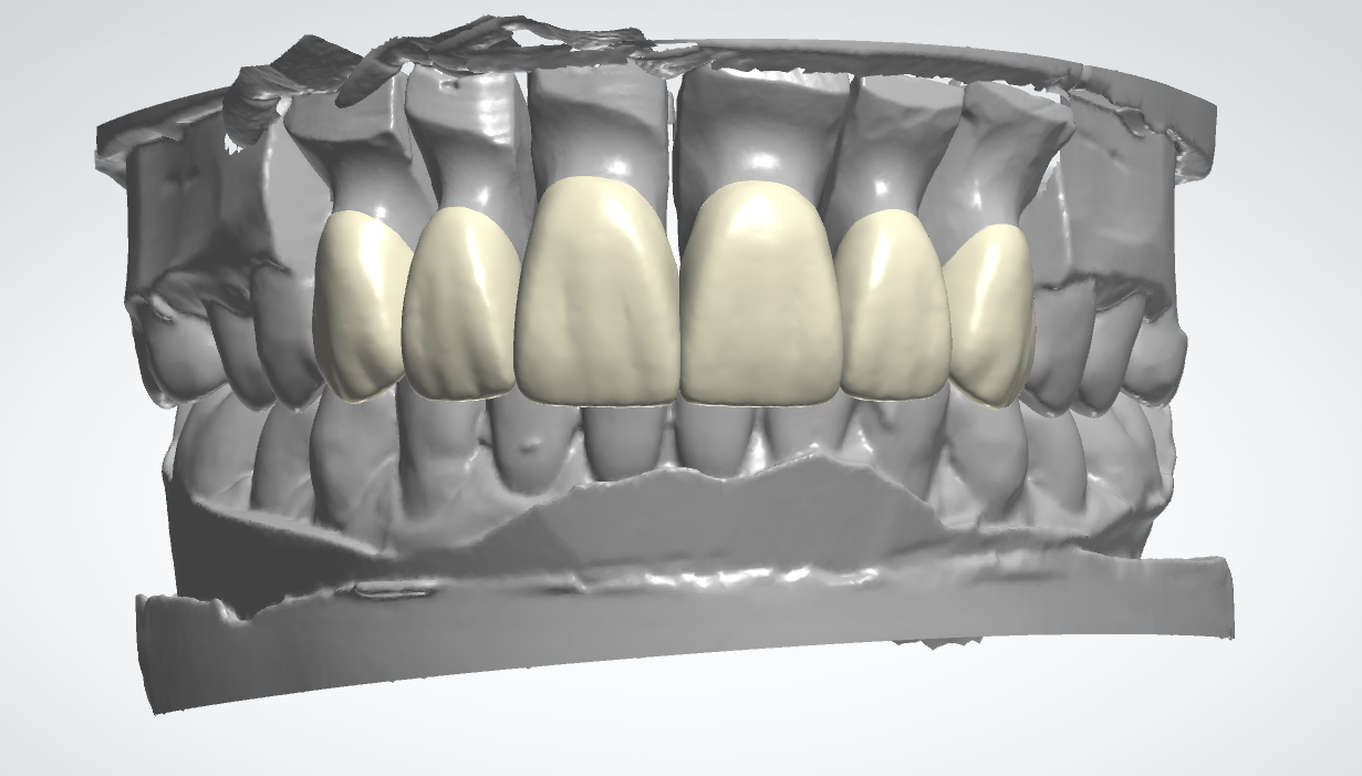 6 Units Anterior Design
